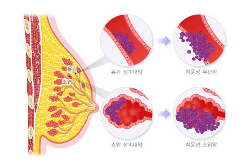 발생부위